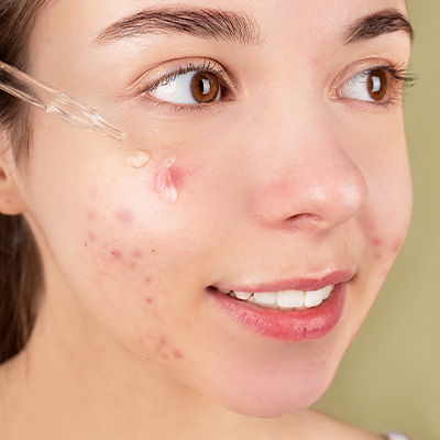 A woman putting serum on her cheek acne